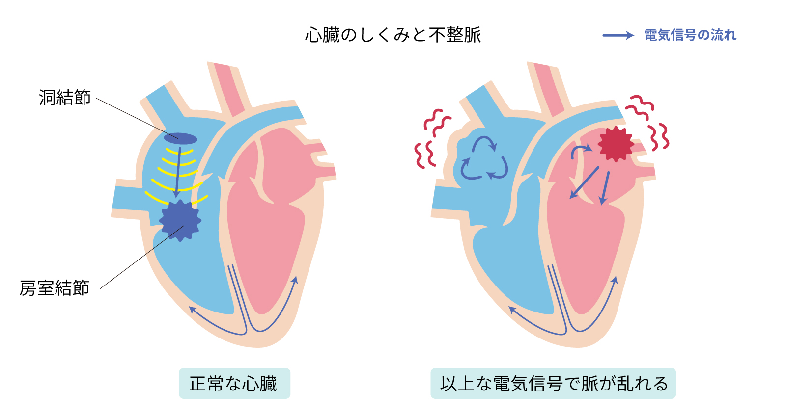 不整脈の治療法|薬物・手術療法や生活習慣の見直しについて | 不整脈の名医